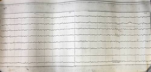 Copy of pp. 12-13 for an electroencephalograph (EEG) test performed on Jack Ruby